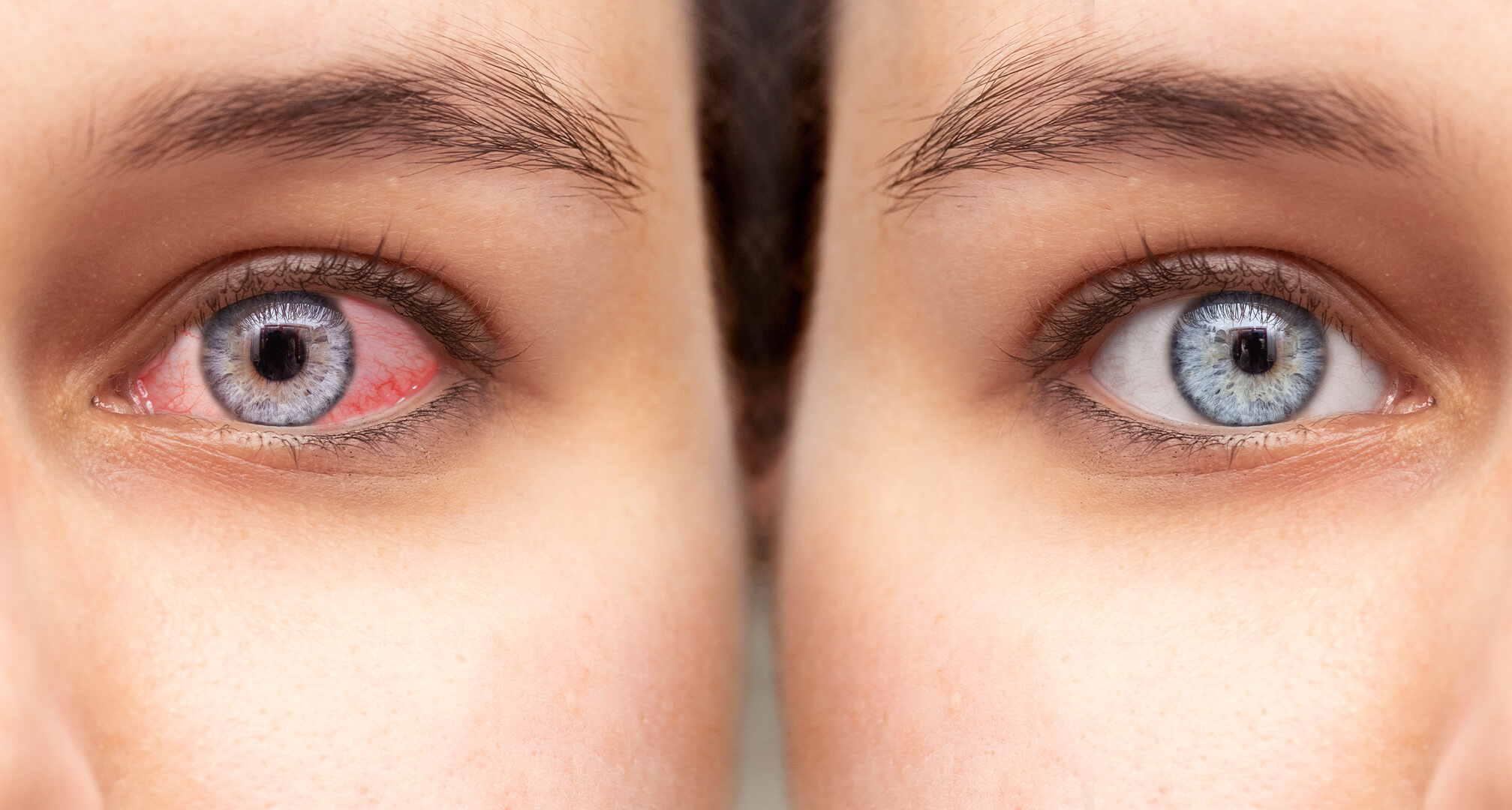 detailní záběr dvou očí vedle sebe, červené suché oko vlevo a zdravé oko vpravo.