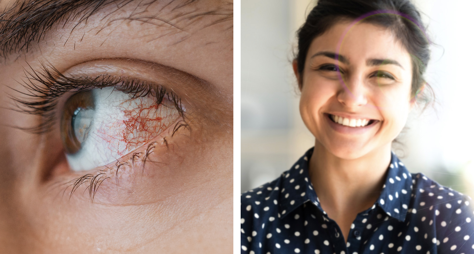 Fotokeratitida může vést k zarudnutí nebo podlití očí krví (vlevo). I když tomu tak není vždy, může vést k rozmazanému vidění nebo příznakům, jako je vidění haló v zorném poli (vpravo).