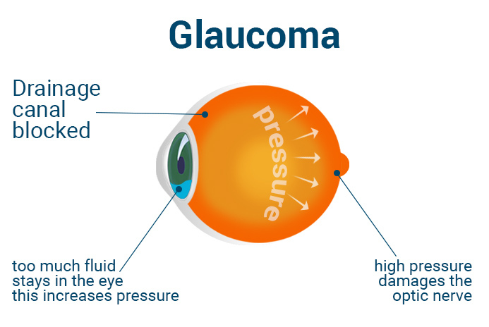 anatomia occhio con glaucoma