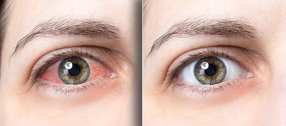 Intrekking verachten landelijk Rode ogen: Lijst van veel voorkomende oorzaken & remedies | Lentiamo