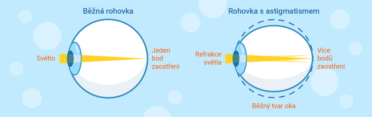 typical and astigmatism cornea