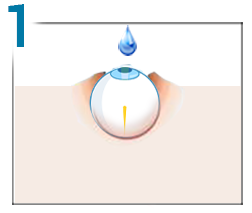 corectarea intra-lasik a vederii)