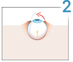 chirurgia vederii cu laser plus)