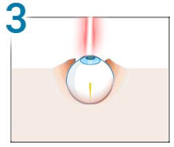 corectarea vederii cu laser dacă plus